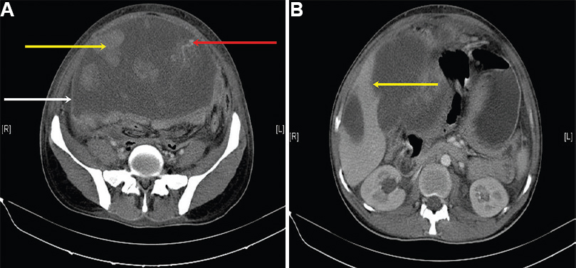 (A) Contrast-enhanced computed tomography abdomen showing large heterogeneous cystic lesion (white arrow) with multiple solid appearing (yellow arrow), irregular, non-enhancing densities within. Also noted is a vessel arising from the anterior abdominal wall (red arrow) (suspected source of haemoperitoneum). (B) Contrast-enhanced computed tomography abdomen showing the cystic lesion scalloping the left lobe of liver (arrow).